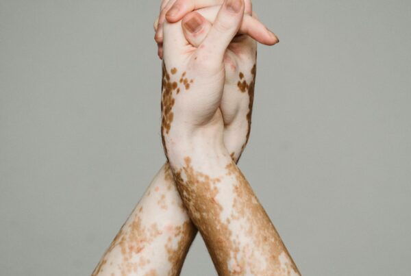 Los brazos de una persona con Vitiligo cogiendo sus propias manos.
